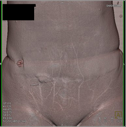 Hernia Through Muscle in Right Lower Quadrant - CTisus CT Scan