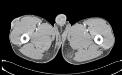 Skin Abscess - CTisus CT Scan