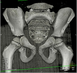 Normal Hips - CTisus CT Scan