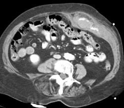 Acute Rectus Bleed - CTisus CT Scan