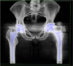 Total Hip Replacement (THR) With Several Renderings - CTisus CT Scan