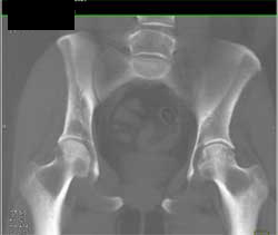 Avascular Necrosis (AVN) Right Hip - CTisus CT Scan