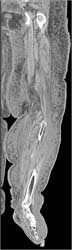 Cellulitis - CTisus CT Scan