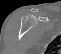 Humerus Fracture - CTisus CT Scan