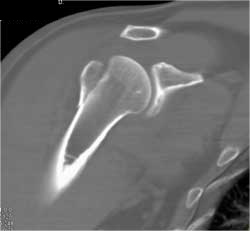 Humerus Fracture - CTisus CT Scan