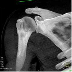 Humerus Fracture - CTisus CT Scan