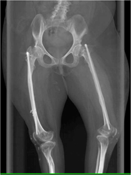 Osteogenesis Imperfecta - CTisus CT Scan