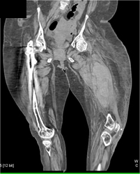 Bleed in Thigh - CTisus CT Scan