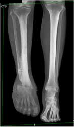 Radiation Dermatitis - CTisus CT Scan