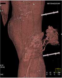 Trauma to Superficial Femoral Artery (SFA) With Laceration - CTisus CT Scan