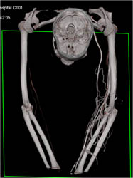 Normal Arm - CTisus CT Scan