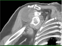 Dislocated Shoulder Joint - CTisus CT Scan