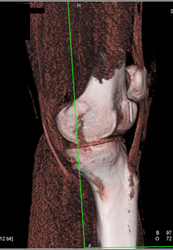 Needle in Joint Space - CTisus CT Scan