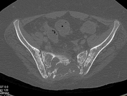 Myelomatosis Sacrum - CTisus CT Scan