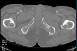 Renal Cell Metastatic to Bone - CTisus CT Scan