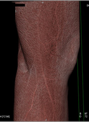 Muscle Definition Around Knee - CTisus CT Scan