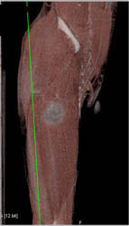 Abscess Thigh With Multiple Renderings - CTisus CT Scan