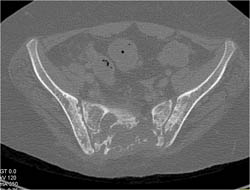 Myeloma - CTisus CT Scan