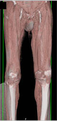 Peripheral Vascular Disease (PVD) With Metastases to Bone - CTisus CT Scan