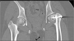 Slipped Capital Femoral Epiphysis (SCFE) With Failed Pinning on the Left - CTisus CT Scan