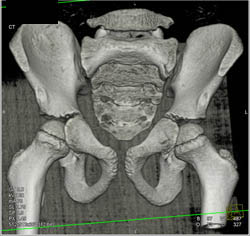 Normal Pelvis and Epiphyses in A Child - CTisus CT Scan