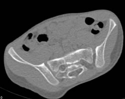 Widened Left SI Joint S/P Trauma - CTisus CT Scan