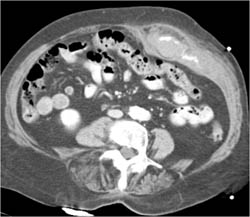 Active Bleeding in Abdominal Wall - CTisus CT Scan