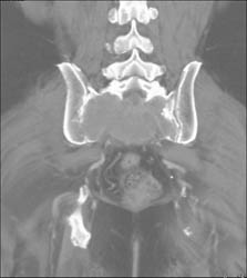 Chordoma - CTisus CT Scan