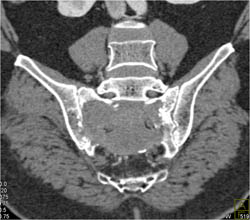 Chordoma - CTisus CT Scan