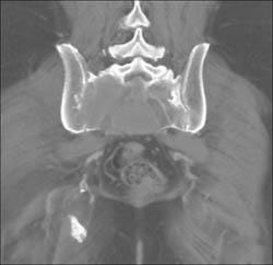 Chordoma - CTisus CT Scan