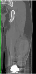 Soft Tissue Hematoma - CTisus CT Scan