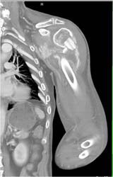 Fracture Through Pathologic Bone - CTisus CT Scan