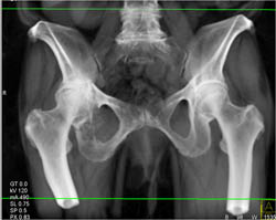 Lytic Lesion Right Acetabulum Was Metastatic Renal Cell Carcinoma - CTisus CT Scan