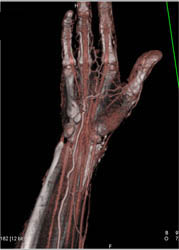 CTA of the Hand - CTisus CT Scan