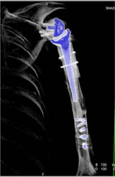 Total Shoulder Replacement - CTisus CT Scan