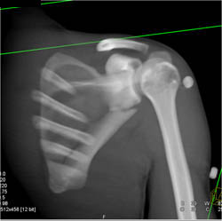 Scapular Fracture - CTisus CT Scan