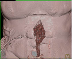 Wound Packed With Gauze - CTisus CT Scan