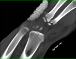 Distal Radius Fracture - CTisus CT Scan