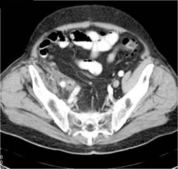 Iliopsoas Abscess With Air Bubbles - CTisus CT Scan