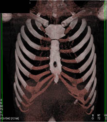 Pectus Deformity - CTisus CT Scan