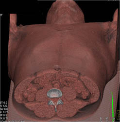 Pectus Deformity - CTisus CT Scan