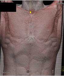 Pectus Deformity - CTisus CT Scan