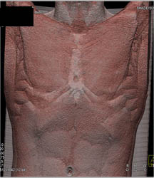 Pectus Deformity - CTisus CT Scan