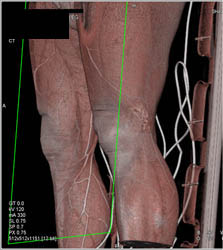 Injury to Knee With Normal CTA - CTisus CT Scan