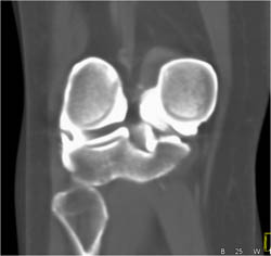 Normal CT Arthrogram - CTisus CT Scan