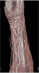 Arteriovenous Malformation (AVM) of the Wrist - CTisus CT Scan