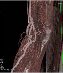 Arteriovenous Malformation (AVM) of the Shoulder - CTisus CT Scan