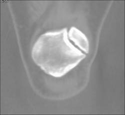 Bipartate Patella - CTisus CT Scan