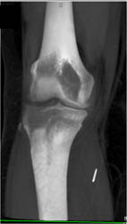 Foreign Body Near Knee- Needle - CTisus CT Scan