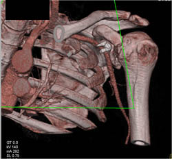 Scapular Fracture - CTisus CT Scan